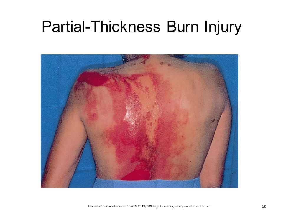 Inflammation and full thickness burn